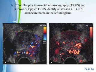 Powerpoint Templates
Page 63
A. Color Doppler transrectal ultrasonography (TRUS) and
B. Power Doppler TRUS identify a Gleason 4 + 4 = 8
adenocarcinoma in the left midgland
 