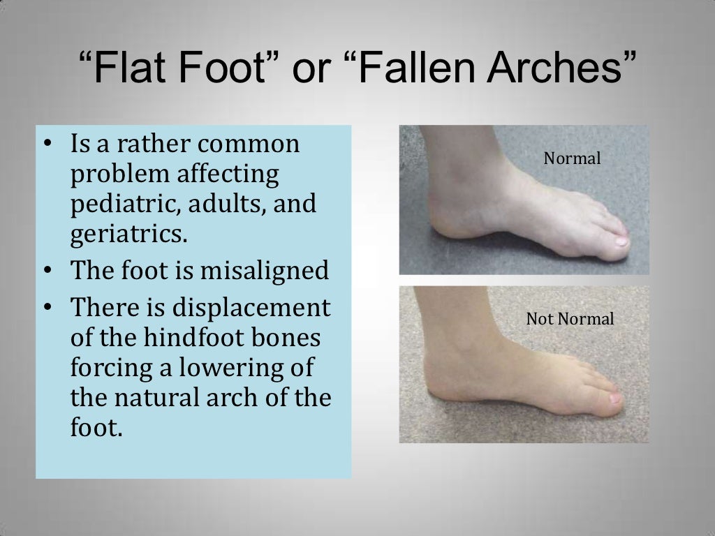  Flat Feet Treatment  Options