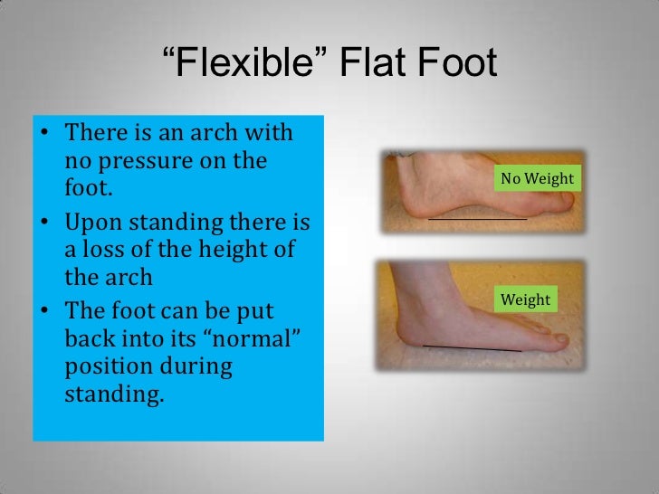 Flat Feet Treatment Options