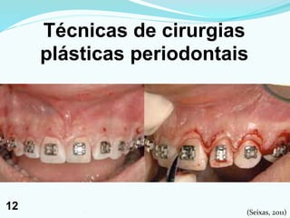 Técnicas de cirurgias
plásticas periodontais
(Seixas, 2011)121
12
 