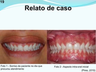 Relato de caso
Foto 1 - Sorriso da paciente no dia que
procurou atendimento
Foto 2 - Aspecto intra-oral inicial
(Pires, 2010)191
19
 