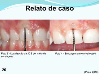Relato de caso
Foto 3 - Localização da JCE por meio de
sondagem
Foto 4 - Sondagem até o nível ósseo
(Pires, 2010)201
20
 