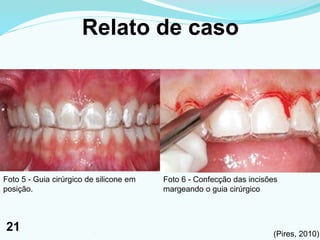 Relato de caso
Foto 5 - Guia cirúrgico de silicone em
posição.
Foto 6 - Confecção das incisões
margeando o guia cirúrgico
(Pires, 2010)211
21
 