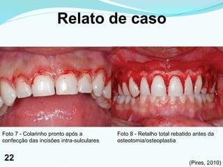 Relato de caso
Foto 7 - Colarinho pronto após a
confecção das incisões intra-sulculares
Foto 8 - Retalho total rebatido antes da
osteotomia/osteoplastia
(Pires, 2010)221
22
 