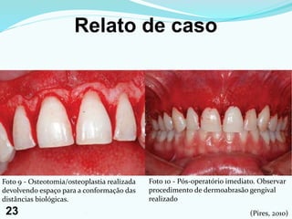 Relato de caso
Foto 10 - Pós-operatório imediato. Observar
procedimento de dermoabrasão gengival
realizado
Foto 9 - Osteotomia/osteoplastia realizada
devolvendo espaço para a conformação das
distâncias biológicas.
(Pires, 2010)23123
 