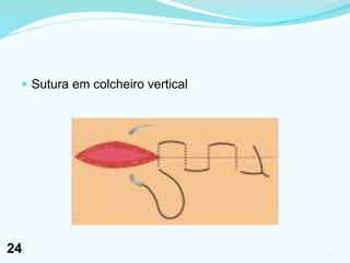  Sutura em colcheiro vertical
241
24
 
