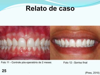Relato de caso
Foto 11 - Controle pós-operatório de 2 meses Foto 12 - Sorriso final
(Pires, 2010)251
25
 
