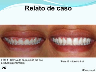 Relato de caso
Foto 12 - Sorriso final
Foto 1 - Sorriso da paciente no dia que
procurou atendimento
(Pires, 2010)261
26
 