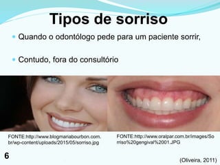 Tipos de sorriso
 Quando o odontólogo pede para um paciente sorrir,
 Contudo, fora do consultório
FONTE:http://www.blogmariabourbon.com.
br/wp-content/uploads/2015/05/sorriso.jpg
(Oliveira, 2011)
FONTE:http://www.oralpar.com.br/images/So
rriso%20gengival%2001.JPG
61
6
 