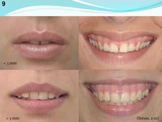 < 3 mm
> 3 mm (Seixas, 2011)91
9
 