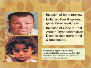  Invasion of bone marrow
 Enlarged liver & spleen,
generalized weakness.
 Invasion of CNS: In East
African Trypanosomiasis:
Disease runs more rapid
& fatal course
Romana’s sign (Unilateral
conjunctivitis appear suddenly)
together with edema of upper &
lower eye lids & cheek
 