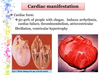 Cardiac manifestation
 Cardiac form:
30-40% of people with chagas. Induces arrhythmia,
cardiac failure, thromboembolism, atrioventricular
fibrillation, ventricular hypertrophy
 