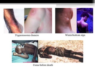 Winterbottom signTrypanosoma chancre
Coma before death
 