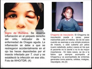 Signo de Romana. Se observa
inflamación en el párpado derecho
del niño, indicador de la
enfermedad de Chagas aguda. La
inflamación se debe a que se
restregaron accidentalmente en el
ojo las heces depositadas por el
insecto infectado por T. cruzi y se
estableció la infección en ese sitio.
Foto de WHO/TDR. (4)
Chagoma de inoculación. El Chagoma de
inoculación puede a veces, pasar
inadvertido para el médico. Se da tal caso
cuando se asemeja a una simple picadura
de insecto, o está cubierta por pelos
(cuero cabelludo, pubis,) casos en los que
el paciente no lo siente o no le da mayor
importancia . En tales casos, se da a la
fiebre que siempre acompaña al
Chagoma,y va acompañada de síntomas
generales como astenia, cefalea, mialgias,
raquialgias, etc.(5)
 