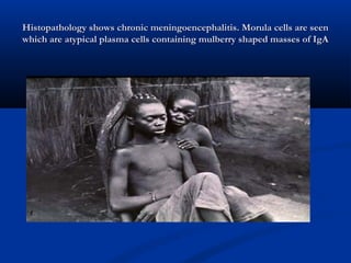 Histopathology shows chronic meningoencephalitis. Morula cells are seenHistopathology shows chronic meningoencephalitis. Morula cells are seen
which are atypical plasma cells containing mulberry shaped masses of IgAwhich are atypical plasma cells containing mulberry shaped masses of IgA
 