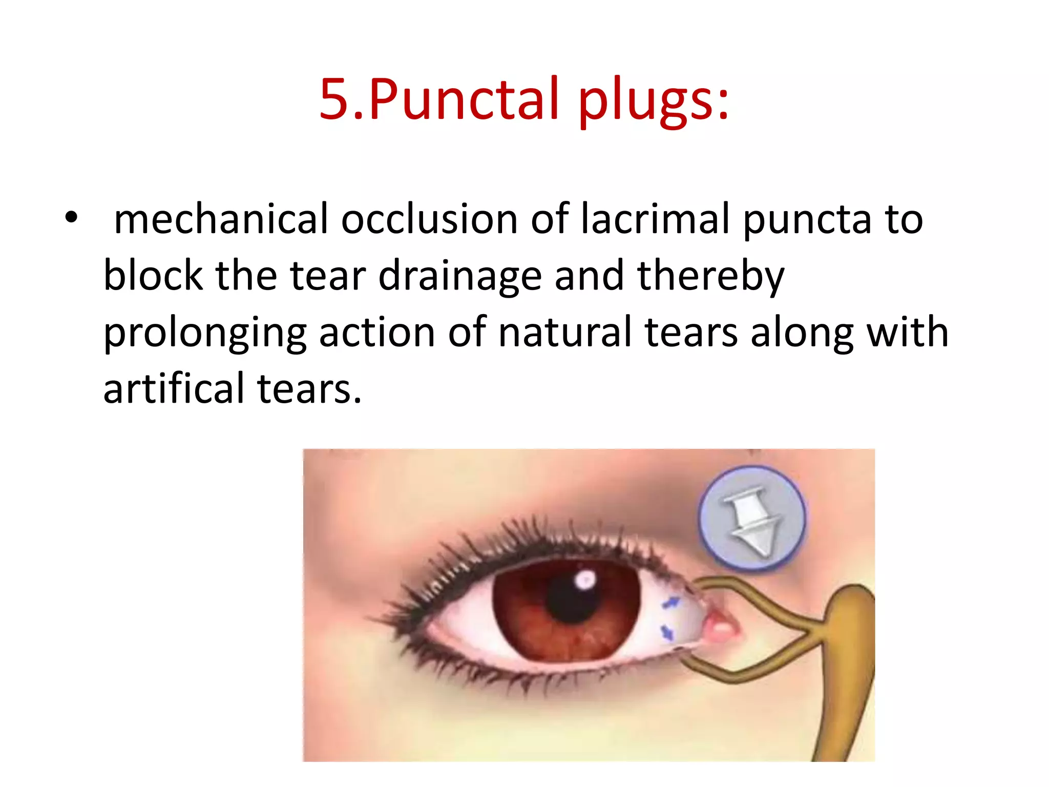 5.Punctal plugs:
• mechanical occlusion of lacrimal puncta to
block the tear drainage and thereby
prolonging action of natural tears along with
artifical tears.
 