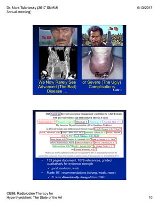 Dr. Mark Tulchinsky (2017 SNMMI
Annual meeting)
6/13/2017
CE88: Radioiodine Therapy for
Hyperthyroidism: The State of the Art 10
We Now Rarely See
Advanced (The Bad)
Disease … Case 1
or Severe (The Ugly)
Complications
Endocrinology Surgery, Endo Pathology 19 Oncology 14 Nuclear Med (Fr)1
• 133 pages document, 1078 references, graded
qualitatively for evidence strength
 good, moderate, weak
• Made 101 recommendations (strong, weak, none)
 21 were diametrically changed from 2009
 