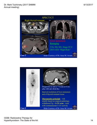 Dr. Mark Tulchinsky (2017 SNMMI
Annual meeting)
6/13/2017
CE88: Radioiodine Therapy for
Hyperthyroidism: The State of the Art 14
Restaging
T1b, N0, M1; Stage IV C
2015 ATA “High Risk”
SPECT/CT
Liver metastasis
Case 2 Slide Courtesy of Dr. Anca M. Avram
Right thyroid remnant
Diagnostic (1 mCi) 131I scan at 6 mo.
after 200 mCi RAI Rx:
Interval resolution of liver metastasis
and of thyroid remnant tissue
Theranostics principle – risk
stratify based on surgical pathology,
withdrawal Tg + I-131 scan – treat
with commensurate I-131 activity
Case 2 Slide Courtesy of Dr. Anca M. Avram
 