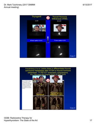 Dr. Mark Tulchinsky (2017 SNMMI
Annual meeting)
6/13/2017
CE88: Radioiodine Therapy for
Hyperthyroidism: The State of the Art 17
Thyrogen®
Case 3
Thyroid Hormone
Withdrawal (THW)≠
Freudenberg LS et al. Lesion dose in differentiated thyroid
carcinoma metastases after rhTSH or thyroid hormone
withdrawal: 124I PET/CT dosimetric comparisons.
Eur J Nucl Med Mol Imaging (2010) 37:2267–2276
Case 4
≠
Thyrogen®
Thyroid Hormone
Withdrawal (THW)
 