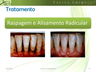 Tratamento18/09/201127Auxiliar de Saúde BucalRaspagem e Alisamento Radicular