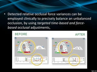 • Detected relative occlusal force variances can be
employed clinically to precisely balance an unbalanced
occlusion, by using targeted time-based and force-
based occlusal adjustments,
 