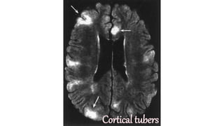 TUBEROUS SCLEROSIS COMPLEX (TSC) | PPTX