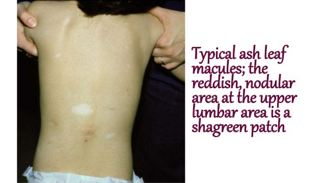 Tuberous Sclerosis Complex Tsc