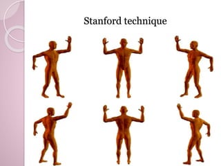Stanford technique 
 