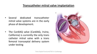 Transcatheter mitral valve implantation
• Several dedicated transcatheter
mitral valve systems are in the early
phase of development.
• The CardiAQ valve (CardiAQ, Irvine,
California) is currently the only trans
catheter mitral valve with a trans
femoral transseptal delivery system
under testing
Trans Septal Puncture(TSP) in Cardiology
 