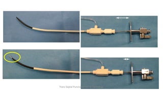 Trans Septal Puncture(TSP) in Cardiology
 