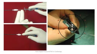 Trans Septal Puncture(TSP) in Cardiology
 