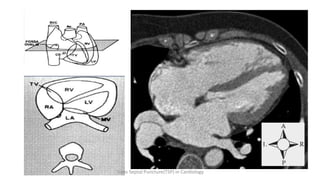 Trans Septal Puncture(TSP) in Cardiology
 