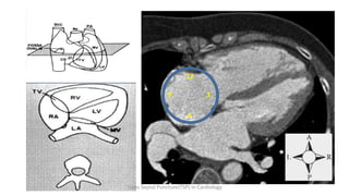 12
9 3
6
Trans Septal Puncture(TSP) in Cardiology
 