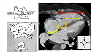 12
9 3
6
IAS plane in supine patient
From 2’ to 7’ o clock
Trans Septal Puncture(TSP) in Cardiology
 