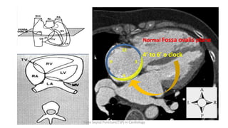 12
9 3
6
Normal Fossa ovalis plane
4’ to 6’ o clock
Trans Septal Puncture(TSP) in Cardiology
 