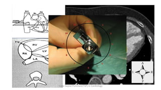 12
9 3
6
Trans Septal Puncture(TSP) in Cardiology
 