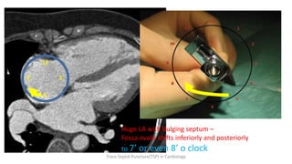 12
9 3
6
Huge LA with Bulging septum –
Fossa ovalis shifts inferiorly and posteriorly
to 7’ or even 8’ o clock
Trans Septal Puncture(TSP) in Cardiology
 