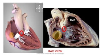 RAO VIEW
Trans Septal Puncture(TSP) in Cardiology
 