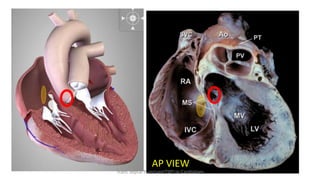 AP VIEW
Trans Septal Puncture(TSP) in Cardiology
 