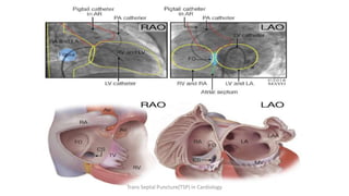 Trans Septal Puncture(TSP) in Cardiology
 