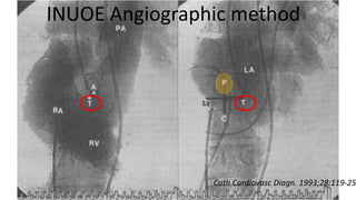 INUOE Angiographic method
Cath Cardiovasc Diagn. 1993;28:119-25
Trans Septal Puncture(TSP) in Cardiology
 