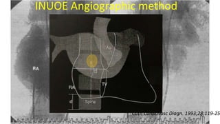 INUOE Angiographic method
Cath Cardiovasc Diagn. 1993;28:119-25
Trans Septal Puncture(TSP) in Cardiology
 