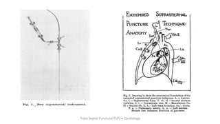 Trans Septal Puncture(TSP) in Cardiology
 