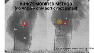 HUNG’S MODIFIED METHOD
(no Angio – only aortic root pigtail)
Cath Cardiovasc Diagn. 1992;26:275-84
Trans Septal Puncture(TSP) in Cardiology
 