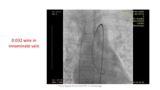 0.032 wire in
innominate vein
Trans Septal Puncture(TSP) in Cardiology
 