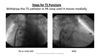 Steps for TS Puncture
Withdraw the TS catheter in PA view until it moves medially
PA or mild LAO RAO
Trans Septal Puncture(TSP) in Cardiology
 