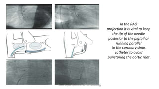In the RAO
projection it is vital to keep
the tip of the needle
posterior to the pigtail or
running parallel
to the coronary sinus
catheter to avoid
puncturing the aortic root
Trans Septal Puncture(TSP) in Cardiology
 
