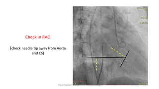 Check in RAO
(check needle tip away from Aorta
and CS)
Trans Septal Puncture(TSP) in Cardiology
 