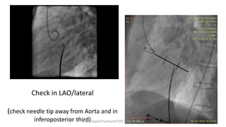 Check in LAO/lateral
(check needle tip away from Aorta and in
inferoposterior third)
Trans Septal Puncture(TSP) in Cardiology
 
