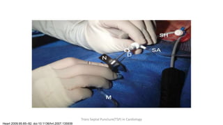 Heart 2009;95:85–92. doi:10.1136/hrt.2007.135939
Trans Septal Puncture(TSP) in Cardiology
 